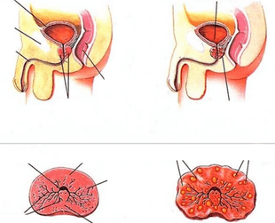 normale Prostata und chronische Prostatitis