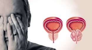 Gesunde und entzündete Prostata