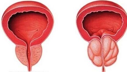 normale und entzündete Prostata