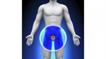 Prostatitis bei einem Mann