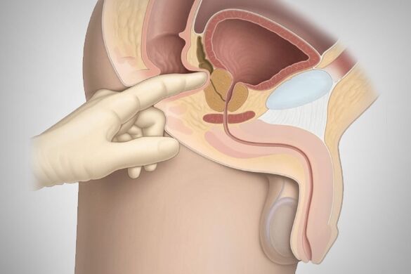 Prostatamassage bei bakterieller Prostatitis