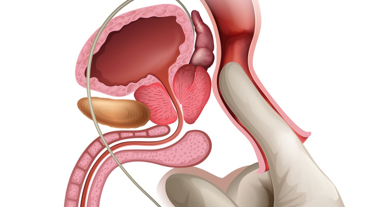 Die Prostatamassage ist eine wirksame Methode zur Behandlung von kongestiver Prostatitis