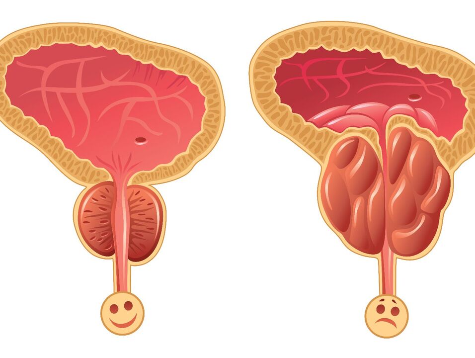 Gesunde Prostata und Prostataverstopfung mit kongestiver Prostatitis